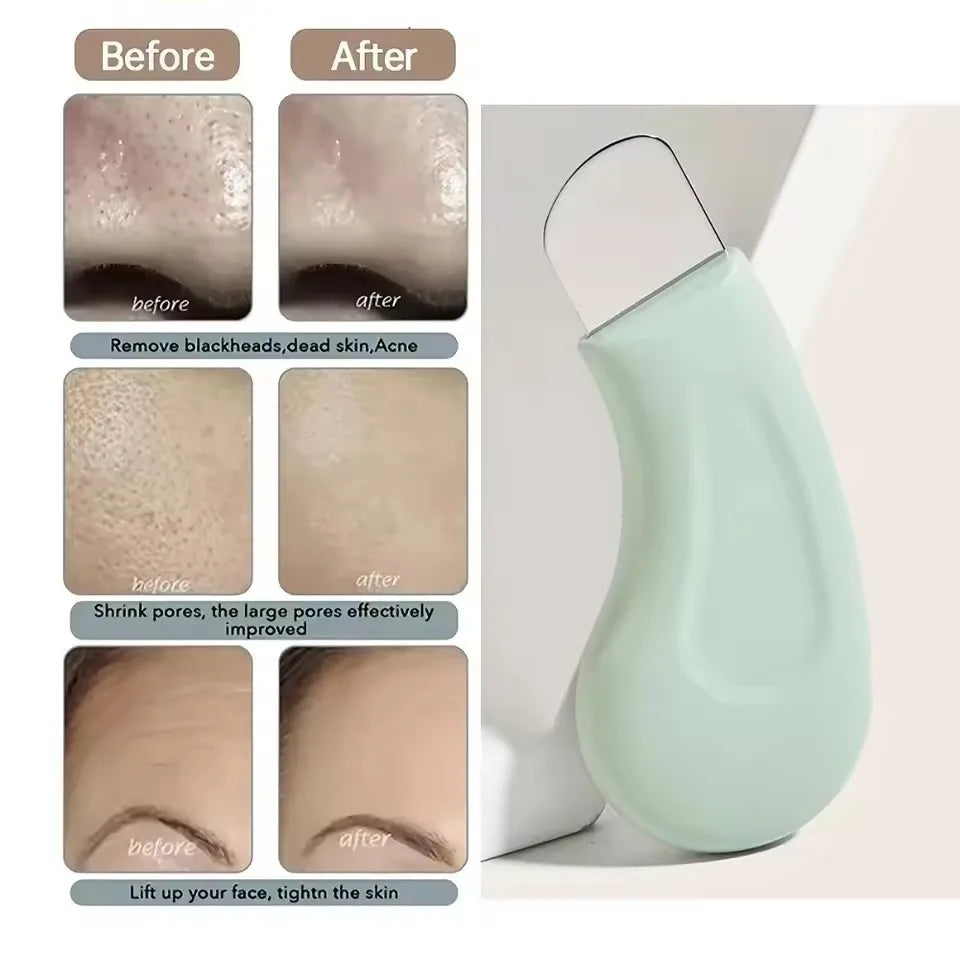 1 pièce — Outil d’extraction des points noirs et points blancs pour le nez et le visage, nettoyeur de pores de la peau, accessoire de soin du visage pour femmes, élimination des points noirs et nettoyage des pores.